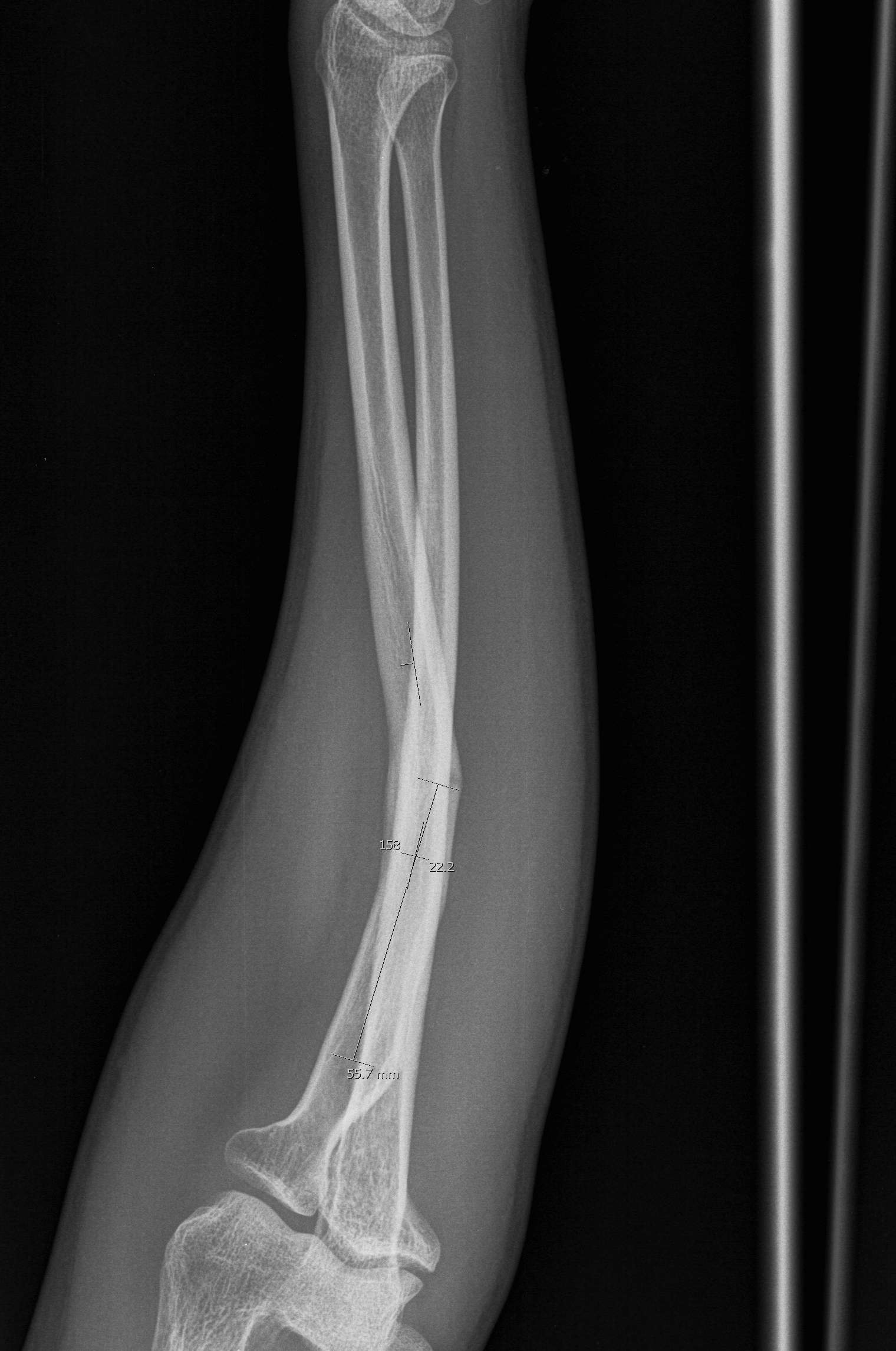 Radial Fracture Malunion 
